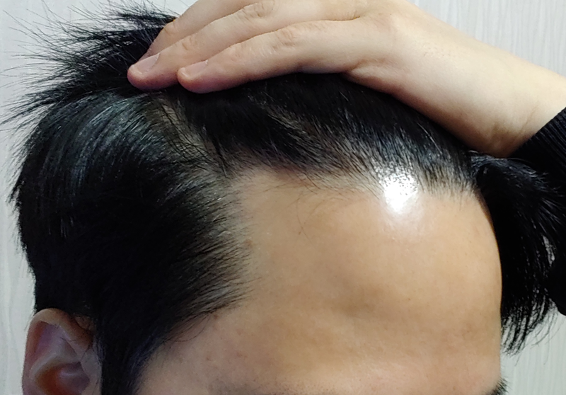 母材性非切開12ヶ月の評価です。