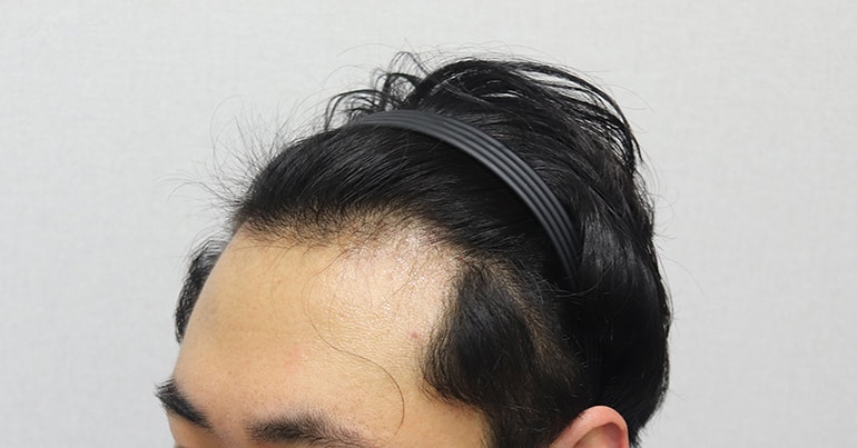 이식 전 왼쪽.JPG