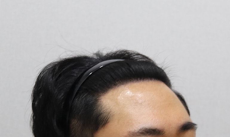이식 후 오른쪽.JPG