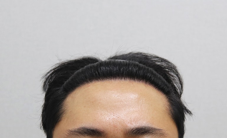 이식 후 정면.JPG