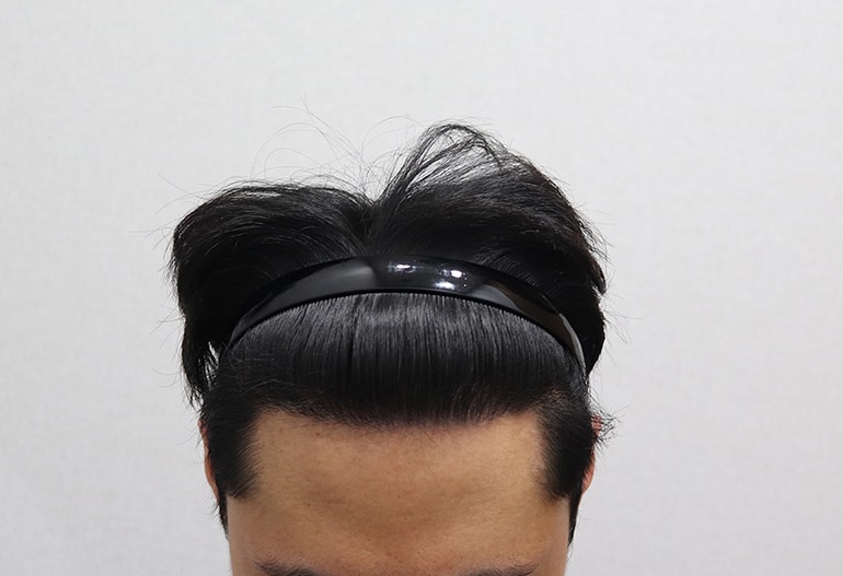 이식 후 윗면.jpg