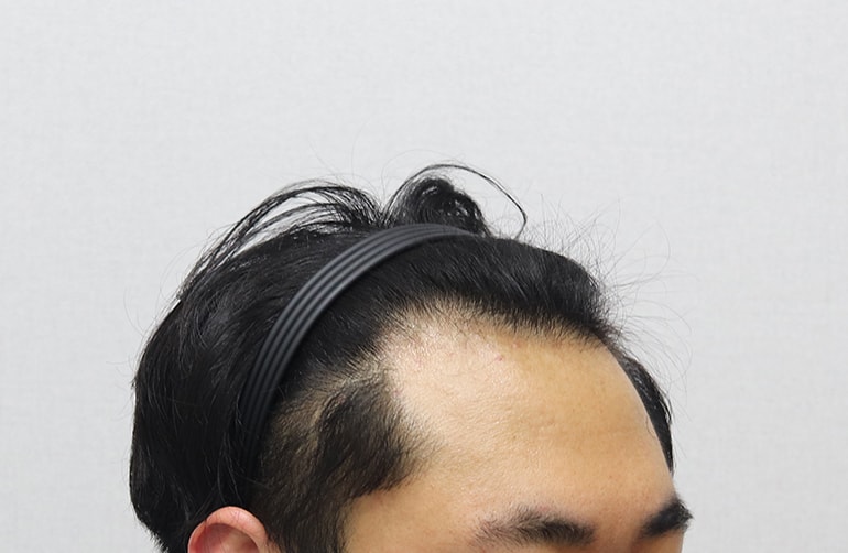 이식 전 오른쪽.JPG