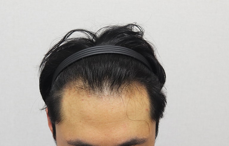 이식 전 정면.JPG
