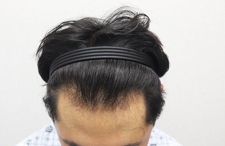 이식 전 윗면.JPG