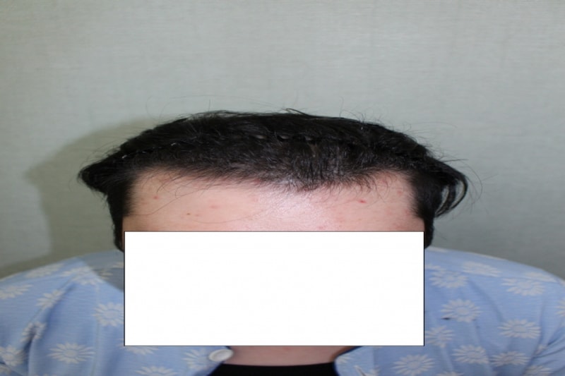 일괄편집_수술전2.JPG