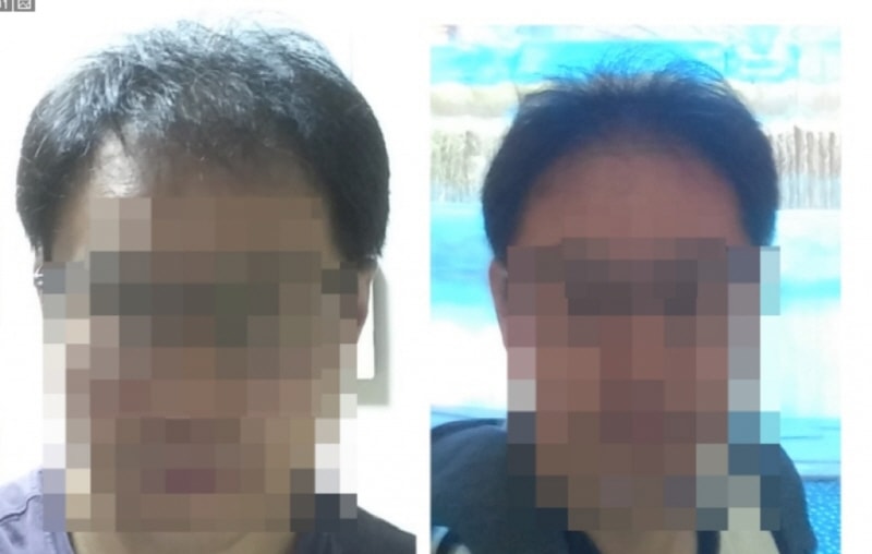 이식9개월후현재.jpg