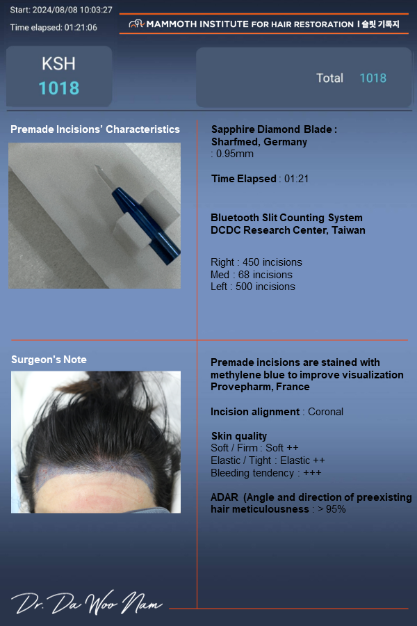 Apgujeong Mamos Nam Dawoo's Hairline Correction Hair Transplantation Review