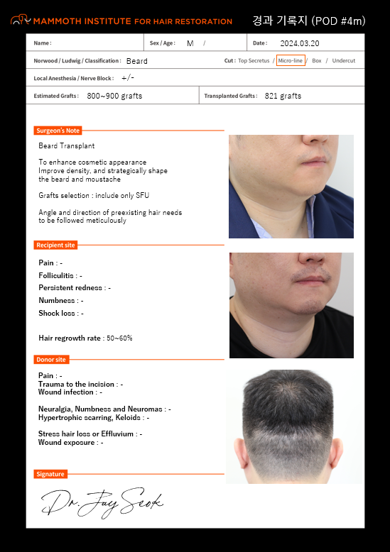 非切开缝隙胡子移植4个月后期。 （狎鸥亭Mammos Hair Line议员）
