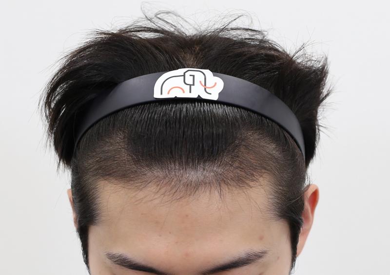 압구정 맘모스 암흑기 끝과 오리지널 프로페시아 처방 후기입니다.