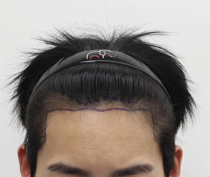 狎鴎亭マンモスヘアラインクリニック非切開植毛 M字と分け目複合手術体験談です。 悩みにとても役立つと思います。