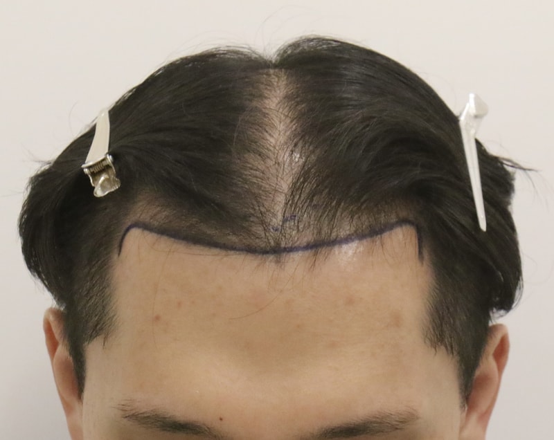 [부산 맘모스헤어 모발이식 당일 후기] 치료 맥스웰에서 하고 약먹다 이식은 맘모스 모발센터에서 시행했습니다. M자랑 전두부 같이 했습니다!