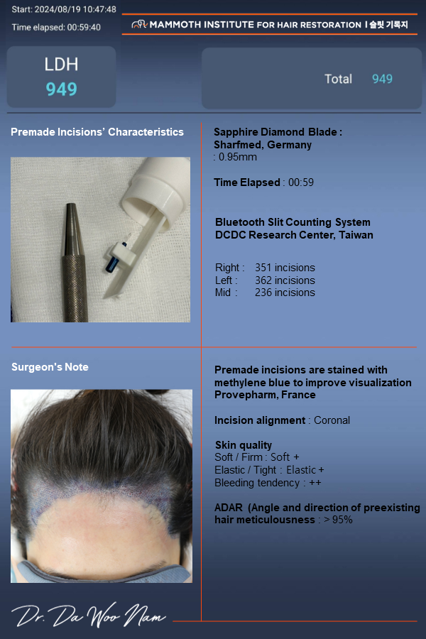 This is the review of the ugly hairline M-shaped hair transplant day of Apgujeong Mamos Nam Dawoo.