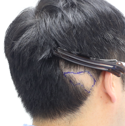 Scars, circular hair loss. It's a review of hair transplantation [Apgujeong's mammoth Nam Dowoo]
