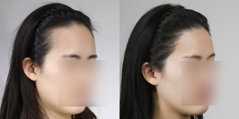 압구정 모우림의원(사진첨부) 여자 3500모 2년차 후기