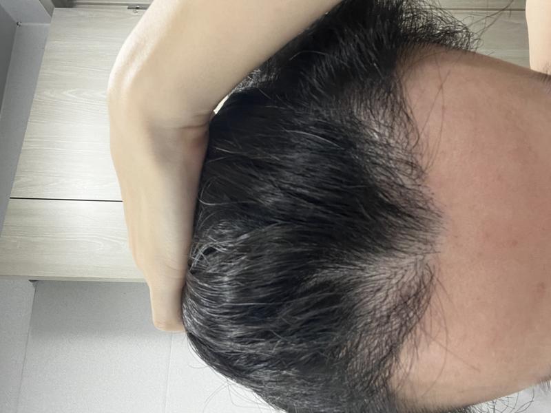 角張った補強120日目