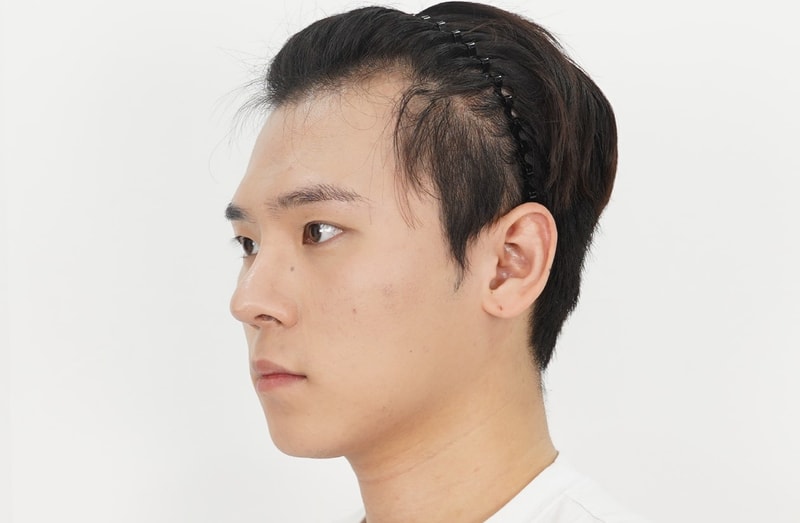 청담오케이모발이식센터 1일차 후기.. 걱정했는데 무색할만큼 만족스럽습니다 ㅎ