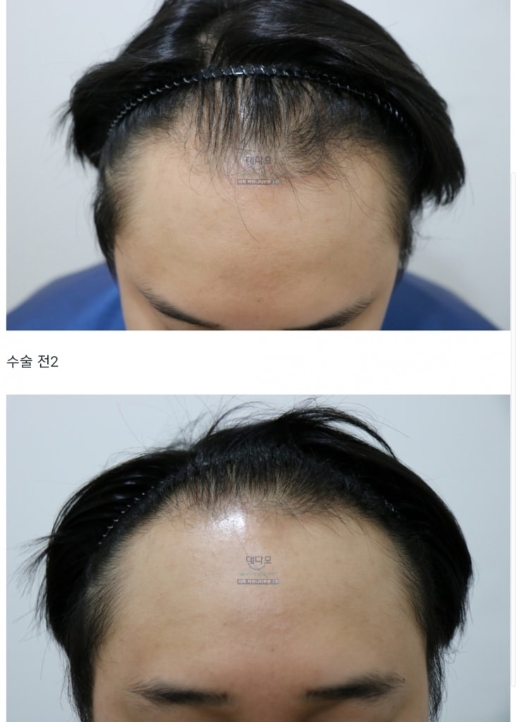 모스트 비절개 3000모 6개월 후기입니다.