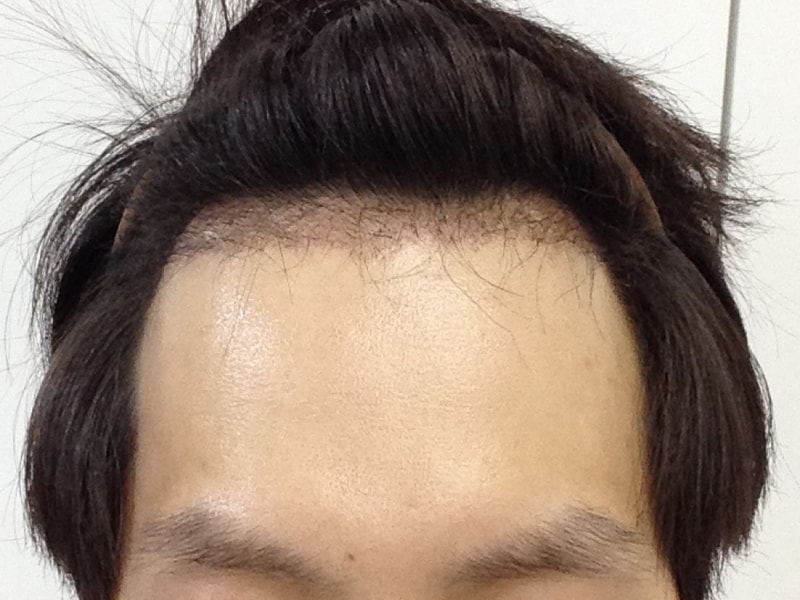 Motion Non-Cutting 1000 Hairline Transplantation 3 Months After Hairline Transplantation