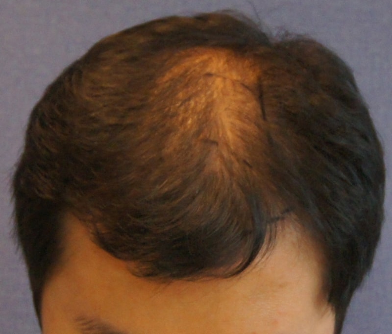 Motion 2600 hair follicle hair transplant 6 months later