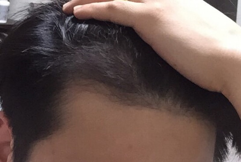 Motion!!! The 177th day, 800 hair follicles from non-cutter feet