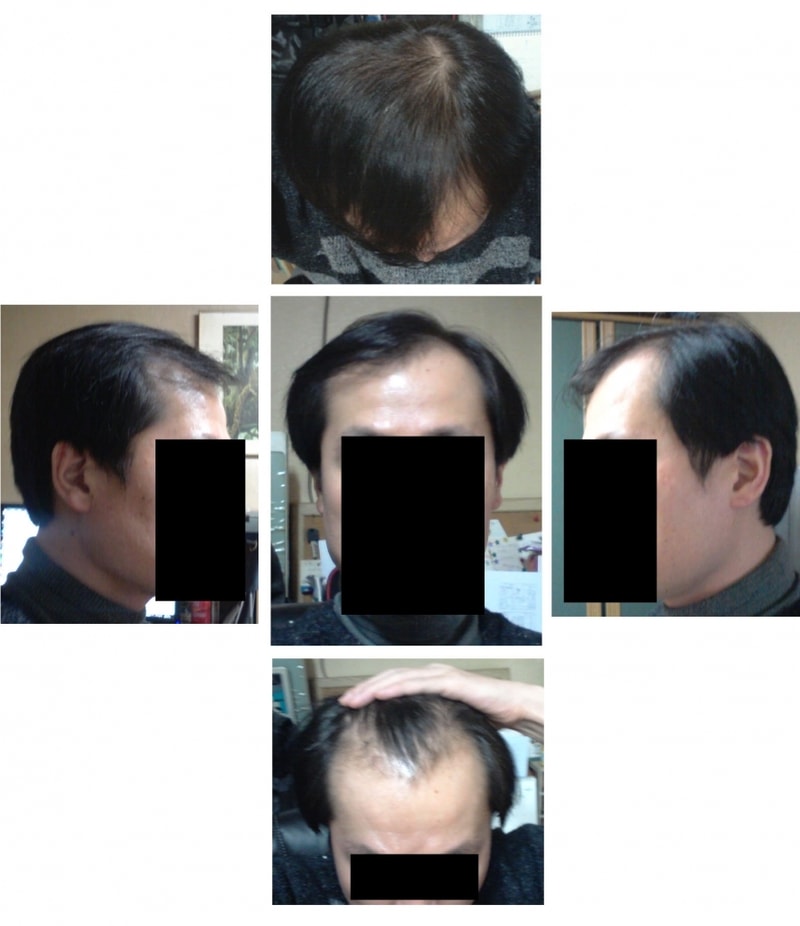 머리사진(수술하루전).jpg
