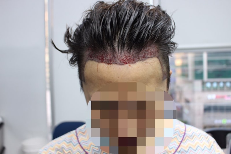 수술직후_정면.jpg