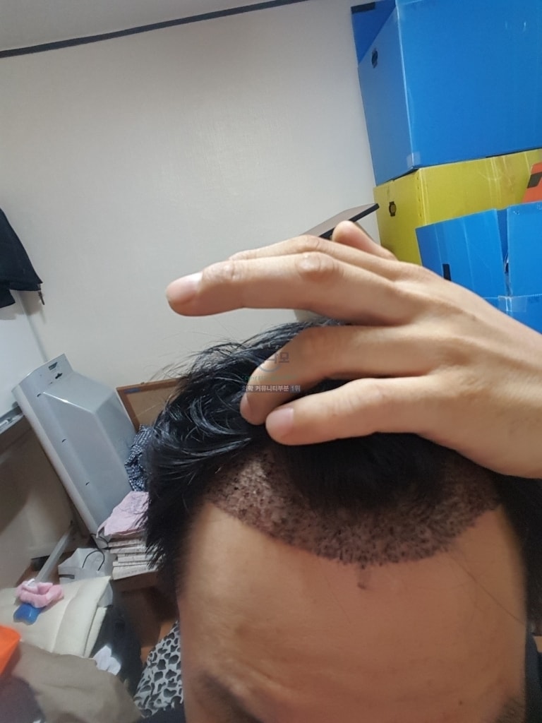 非切开缝隙移植 1200 毛囊 第14天去除痂后