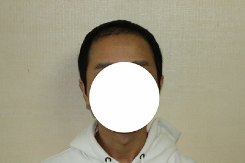 비절개 1600모낭 2개월~