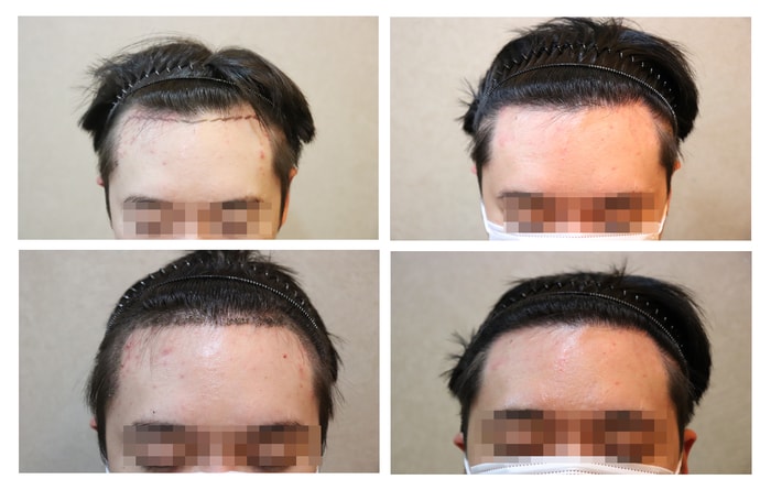 JP Plastic Surgery Non-Cutting 2,500 Mo 6 Months Review