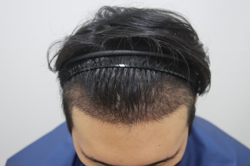 수술2주차.jpg