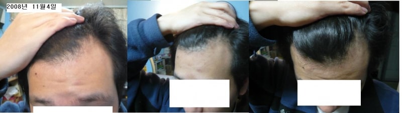 Comparison of hair loss progress last year (November) and this year (July)