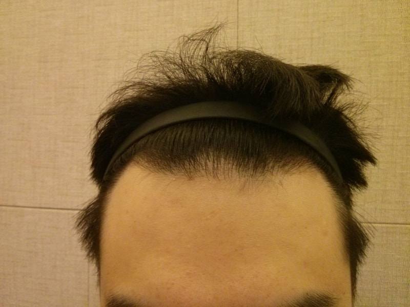 10 months after surgery... (Four Hair) Evaluation, please!!