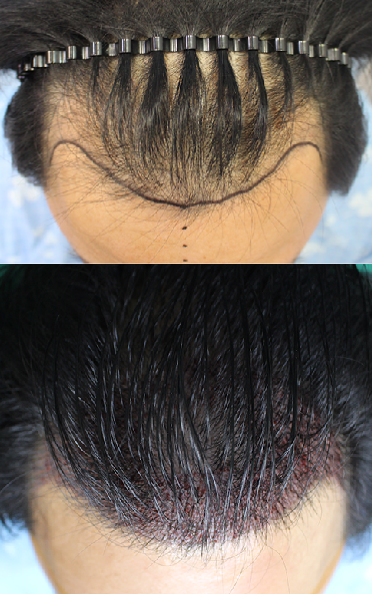 윤병창 모발이식.png