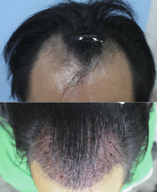 I delayed my hair transplant and now I got it