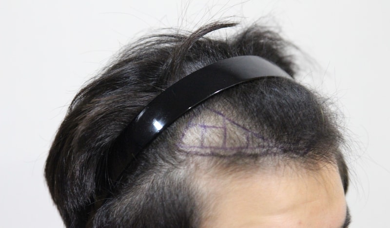 Late stage after 1 year and 6 months of incisional hair transplantation