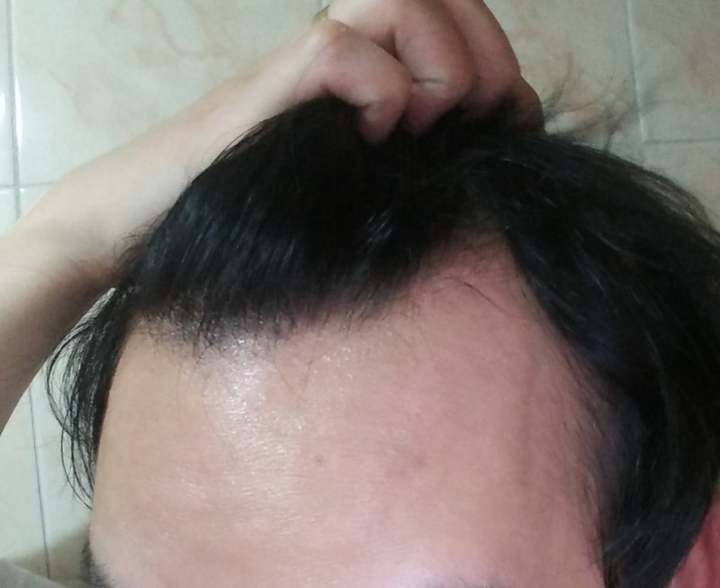 今天做了3400个m字的切开移植过来的。