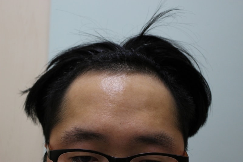 2수술전.JPG