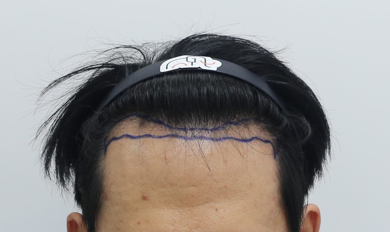 狎鸥亭Mammos Hairine医院2.5周后记