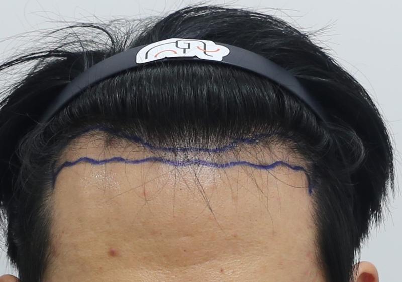 狎鸥亭Mammos Hairine医院第10个月的后记