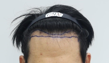 狎鸥亭Mammos Hairine医院的第一天后记