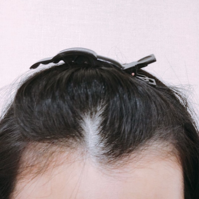 It's been a year since my hairline correction surgery!