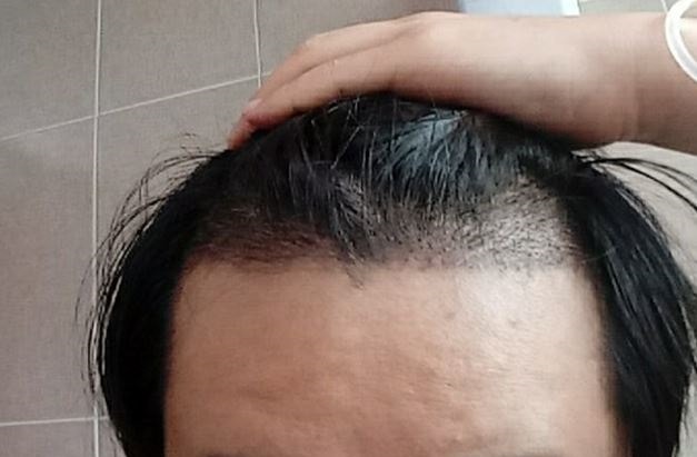 수술 15일차.JPG