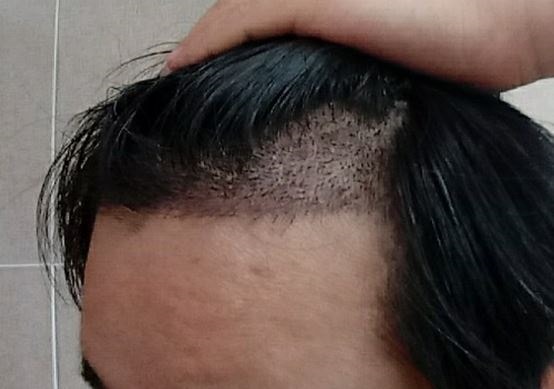 수술 15일차 좌.JPG