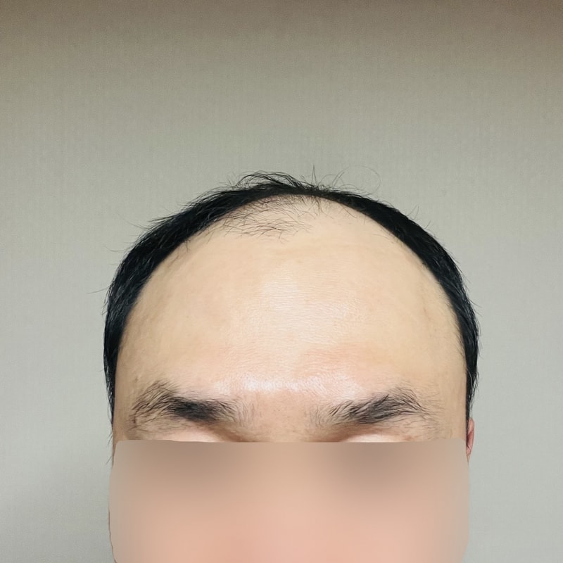 [ディーエイ整形外科] 毛髪移植混用 5000本 イ·ドンウク院長の手術後1週間のレビュー