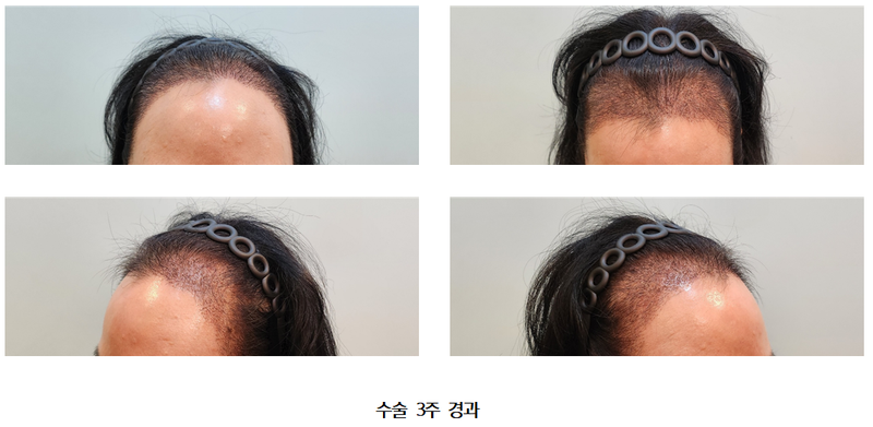 수술 3주 경과.png