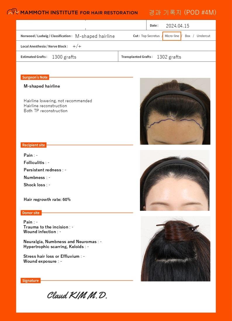 Busan Mammoth Hairline Correction After 4 Months