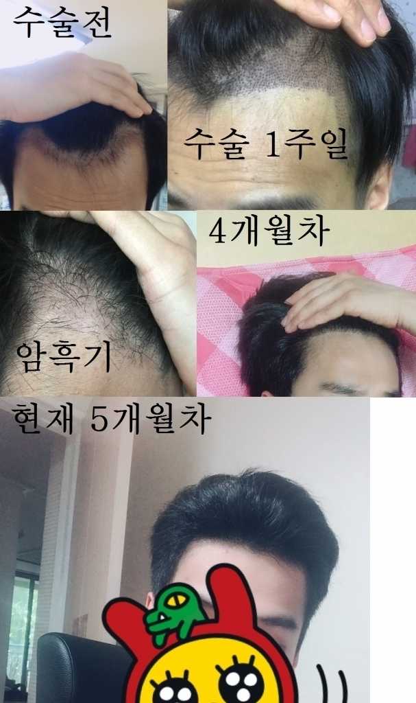 (비절개) 3000모 5개월? 정도차 (건승 한상보 배상)