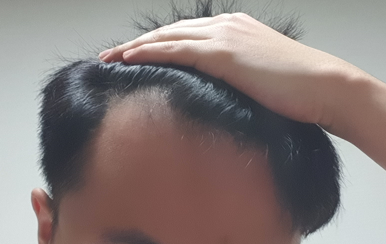 This is the second week of hair transplant..