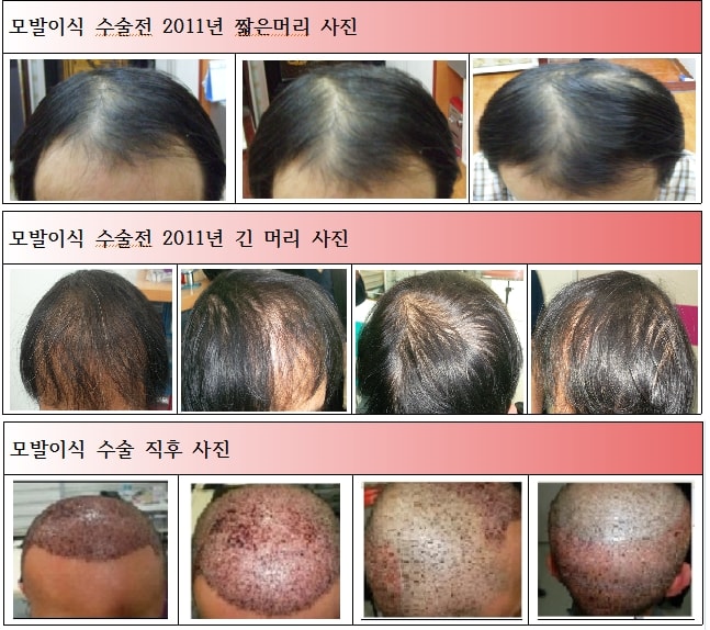 모발이식전후사진.JPG