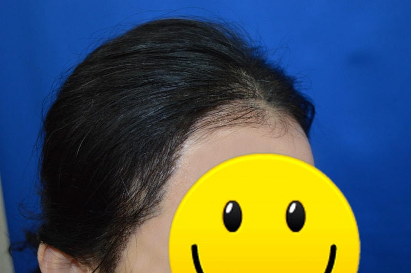 헤어라인교정후옆.jpg